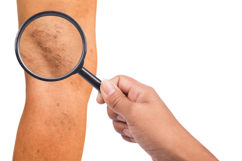 varicose veins