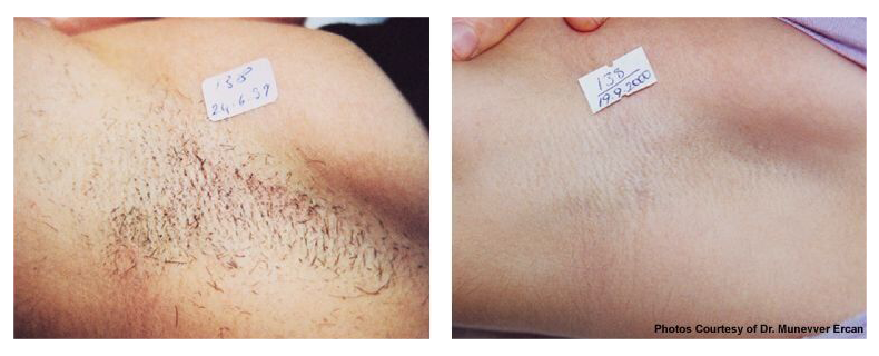 before-after-skin1