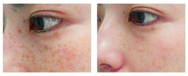 before-after-skin10