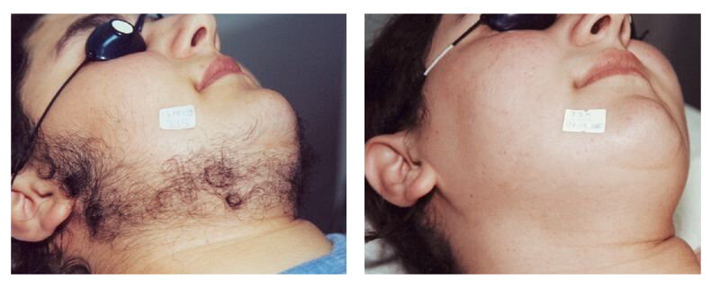 before-after-skin11
