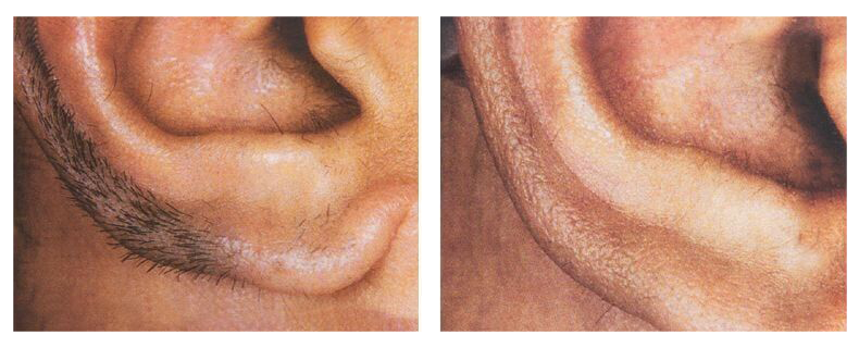 before-after-skin12