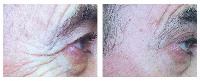 before-after-skin13
