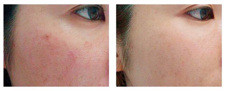 before-after-skin14