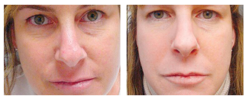 before-after-skin15