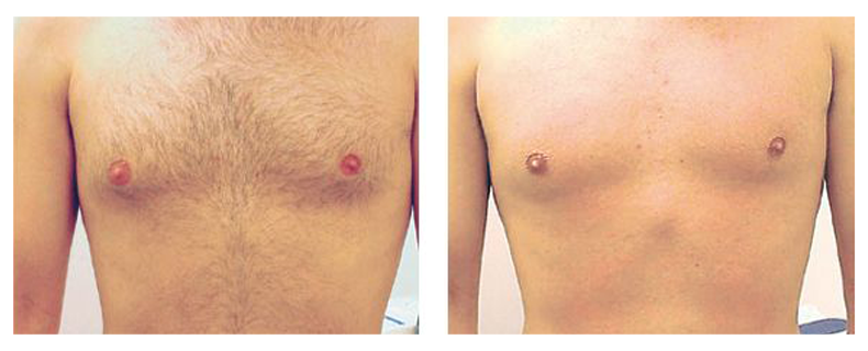 before-after-skin17