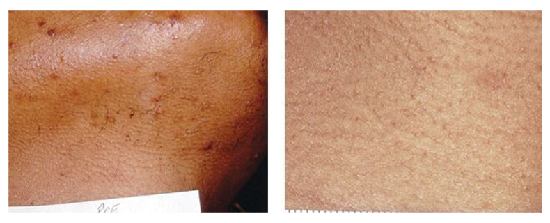 before-after-skin19