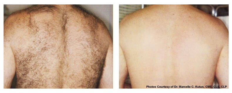 before-after-skin2