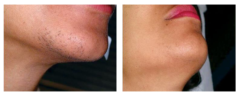 before-after-skin21
