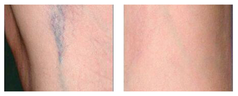 before-after-skin22