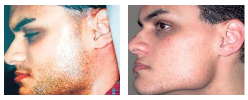 before-after-skin23