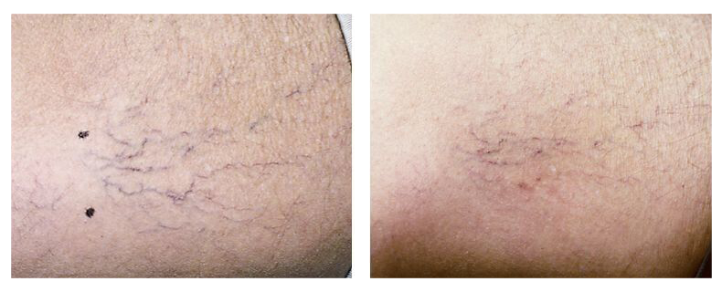 before-after-skin24