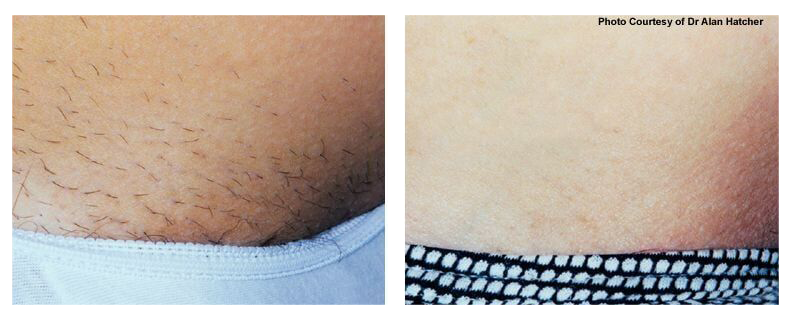 before-after-skin3