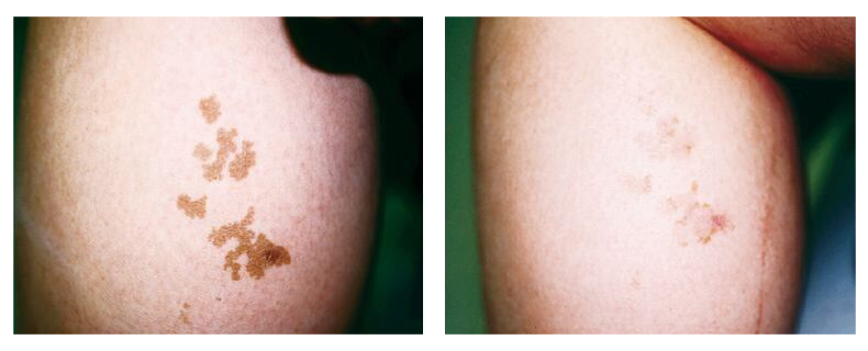 before-after-skin4