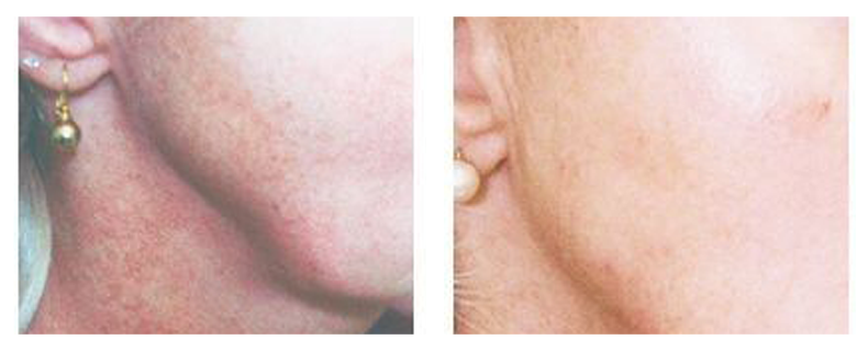 before-after-skin5