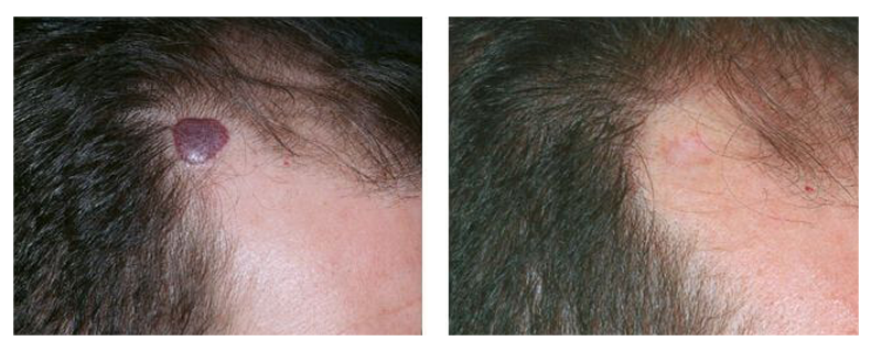 before-after-skin6