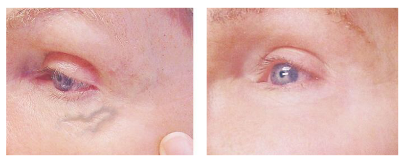 before-after-skin7