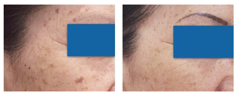 before-after-skin8