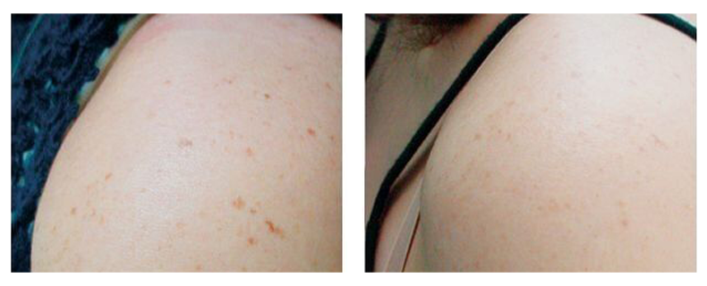 before-after-skin9