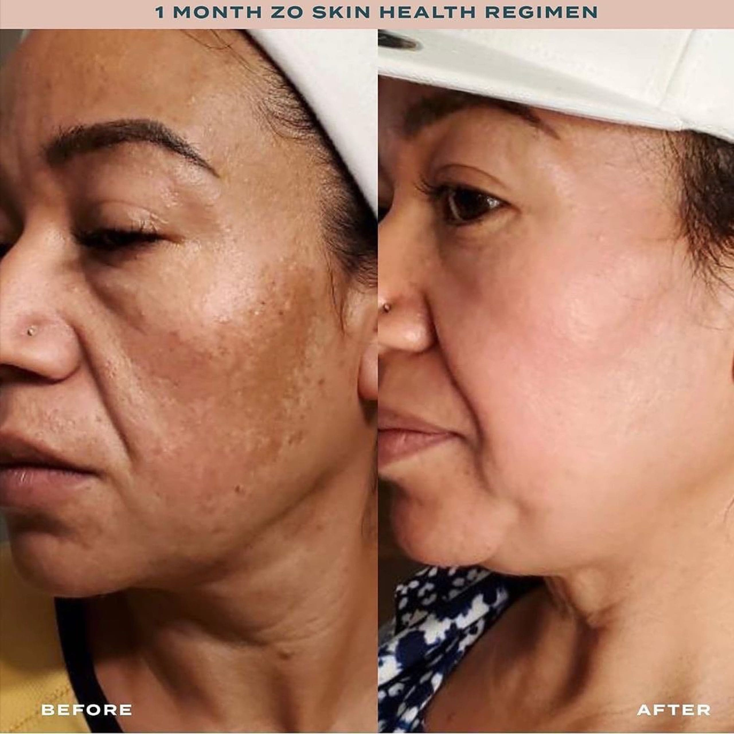 ZO_hydroquinone_and_ RetinARx body contouring with zerona