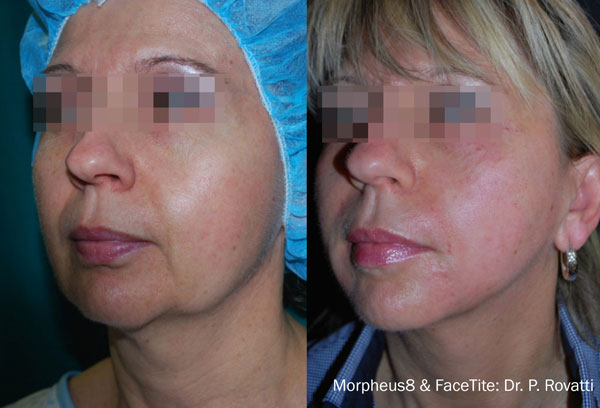 Morpheus8 Microneedling in Gulfport, MS Before and After