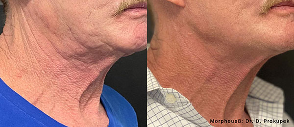 morpheus8-before-after-dr-d-prokupek-preview-1 Morpheus8 Microneedling in Gulfport, MS