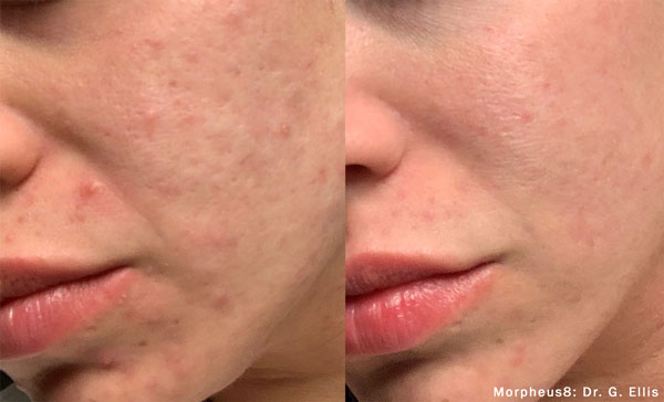Morpheus8 Microneedling in Gulfport, MS Before and After