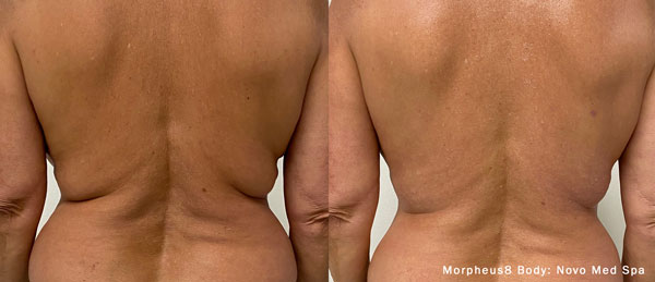 morpheus8-body-before-after-novo-medspa-preview-1 Morpheus8 Microneedling in Gulfport, MS Before and After