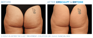 Emsculpt_Emtone_PIC_Ba-card-female-buttock-018_ENUS100