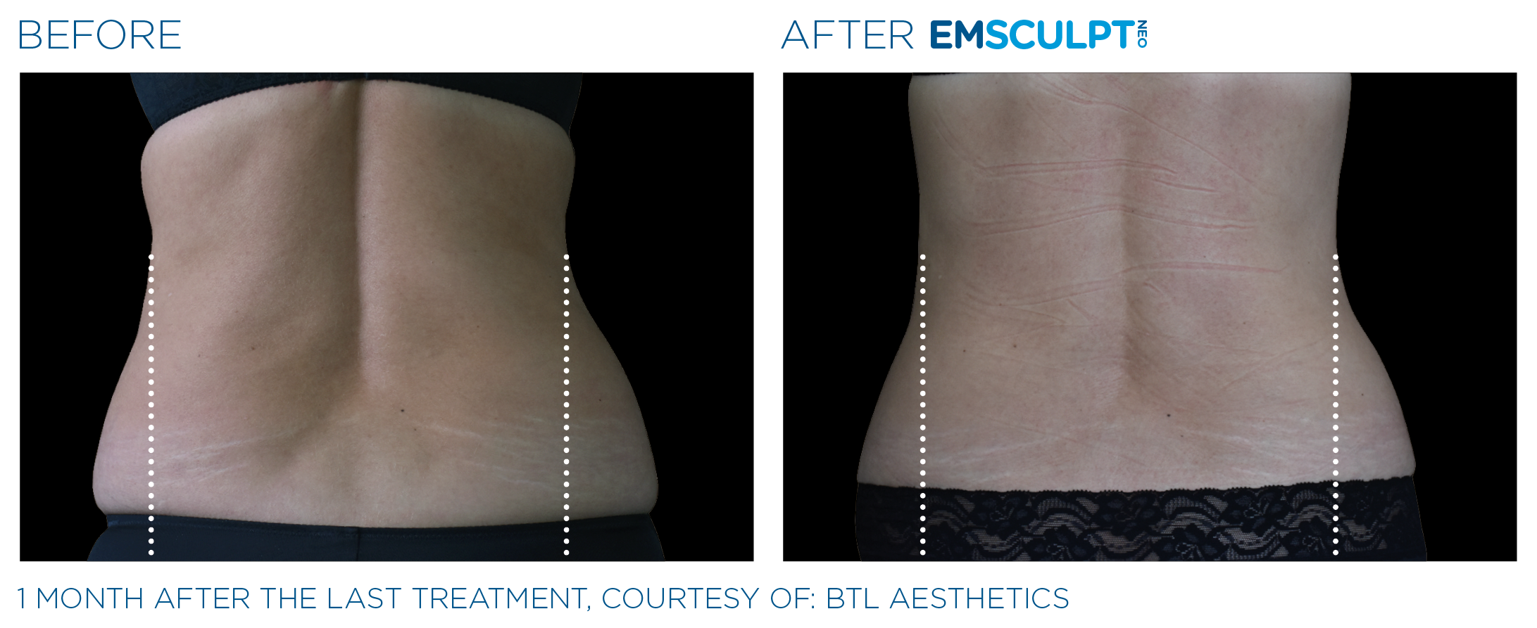Emsculpt_Neo_PIC_Ba-card-female-lateral-abdomen-117_ENUS100 body contouring with zerona