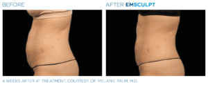 Emsculpt_PIC_Ba-card-female-abdomen-062_ENUS100