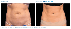 Emsculpt_PIC_Ba-card-female-abdomen-091_ENUS100