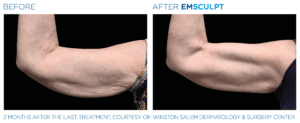 Emsculpt_PIC_Ba-card-female-arms-122_ENUS100