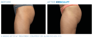 Emsculpt_PIC_Ba-card-female-buttock-045_ENUS100