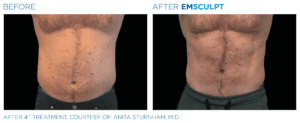 Emsculpt_PIC_Ba-card-male-abdomen-007_ENUS100