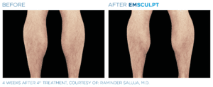 Emsculpt_PIC_Ba-card-male-legs-083_ENUS100