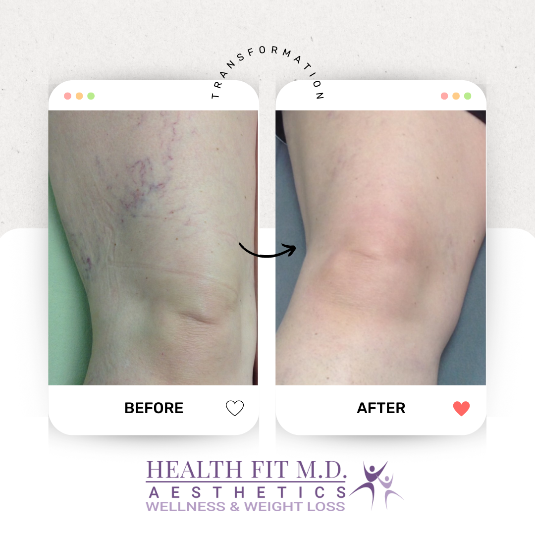 Before and After Spider Vein Removal - Health Fit M.D. Gulfport